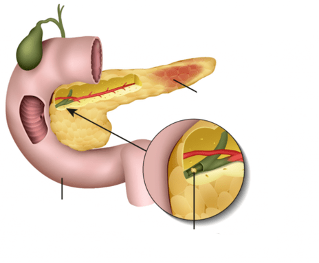 A pancreatite é a inflamación do páncreas
